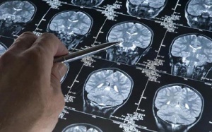 Cholesterol xấu - Kẻ thù của trí nhớ