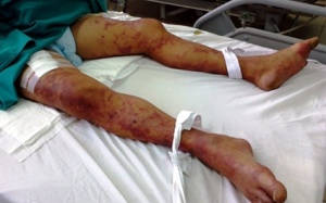 Bùng phát bệnh liên cầu lợn cuối năm