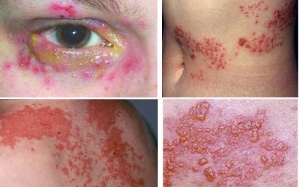 Bệnh zona làm tăng nguy cơ mắc bệnh tim và đột quỵ