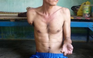 Kinh hoàng người bệnh bất lực nhìn chân tay rụng dần