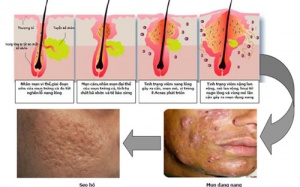 Sử dụng isotretinoin trị trứng cá cần lưu ý gì?