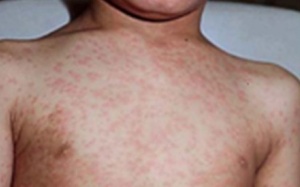 Cha mẹ chú ý: Bệnh sởi gây viêm phổi và chảy mủ tai