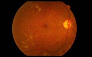 Tầm soát bệnh võng mạc đái tháo đường miễn phí