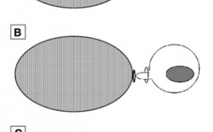 Bệnh hiếm gặp: Tràn dịch màng tinh hoàn, bụng
