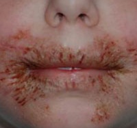 Giấy ướt có thể khiến trẻ bị loét miệng