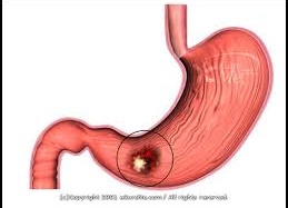 Ung thư dạ dày: Khó phát hiện, tử vong cao