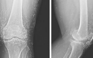 Hàng trăm kim châm cứu bằng vàng trong đầu gối