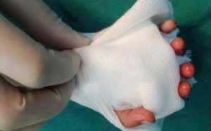 Bệnh nhi nhỏ tuổi nhất được nối chi thành công