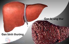 Số ca ung thư tại Iran gia tăng