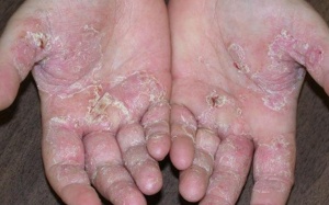 Phân biệt những bệnh về da mùa lạnh