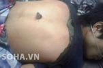 Bị đâm ngập lưỡi dao vẫn được cứu sống
