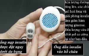 Chữa tiểu đường bằng cấy ghép insulin