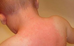 Bộ Y tế ra công điện khẩn vì dịch sởi