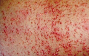 Hiểu đúng về dị ứng