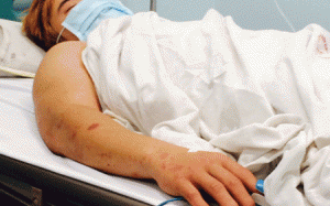 HN: Viêm não mô cầu tái xuất