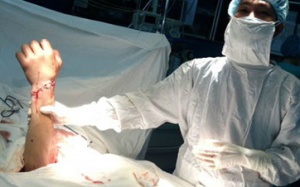 Nối thành công bàn tay bị đứt lìa sau 15 giờ