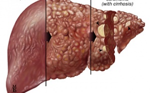 Điều trị ung thư gan thành công bằng hạt vi cầu phóng xạ
