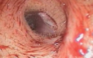 Nữ bệnh nhân bị ấu trùng ruồi giấm khu trú trong tai