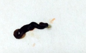 Gắp một con vắt sống dài 4cm trong mắt bệnh nhân