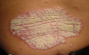 Người bệnh bị ngứa do bệnh vẩy nến