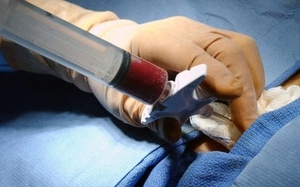 Lần đầu ghép tế bào gốc qua can thiệp mạch