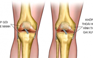 Tế bào gốc mô mỡ tự thân giúp phục hồi sụn khớp