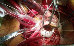 Lần đầu cứu sống trường hợp bị vỡ tim