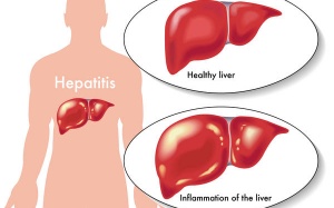 Bệnh viêm gan C có di truyền không?