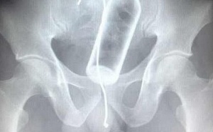 X-quang và nguy cơ ung thư