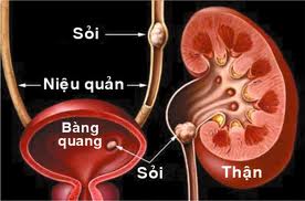 Cắt thận nội soi cho bệnh nhân ung thư thận