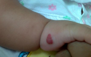 U máu trẻ em có nguy hiểm?