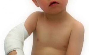 Xương trẻ gãy rất mau lành