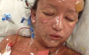 Cô gái phồng rộp toàn thân vì dị ứng thuốc