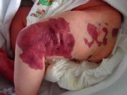 Điều trị thành công cho bé sơ sinh có u máu lớn