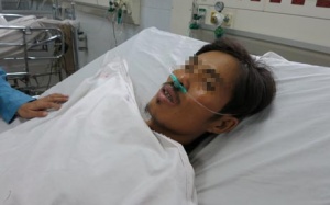 Viêm xương vì châm cứu