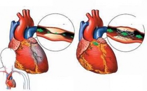 Dấu hiệu báo trước nguy cơ nhồi máu cơ tim