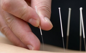 Châm cứu: coi chừng châm xong cấp cứu