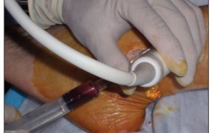 Tiêm huyết tương giàu tiểu cầu trong điều trị thoái hóa khớp gối