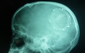 Tái tạo thành công hộp sọ cho bé gái 9 tuổi