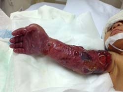 Cứu thành công cánh tay bị hoại tử nặng cho bé sinh non