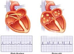 Chất chống đông máu làm giảm nguy cơ đột quỵ ở người rung nhĩ
