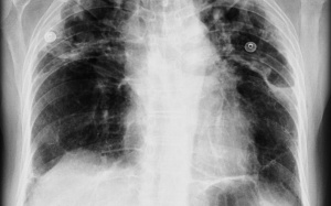 Coi chừng bệnh bụi phổi silic