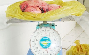 Khối u 7 kg trong bụng cụ bà 78 tuổi