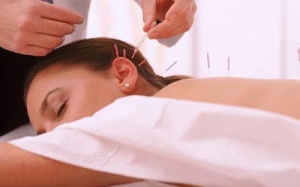 Châm cứu giảm cân - Không thể lạm dụng