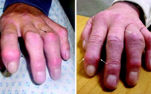 Nhật Bản phát triển thuốc chữa bệnh đa xơ cứng