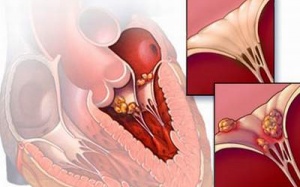 Để khớp không 'đớp' tim