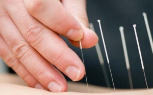Châm cứu có giảm được stress?