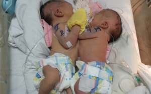 Chuyển cặp song sinh dính liền sang Bệnh viện Nhi đồng 1