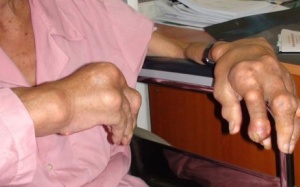 Lắng đọng tinh thể urat ở bệnh nhân gout