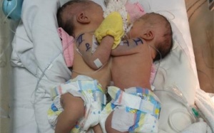 Thêm hai bé sơ sinh dính nhau